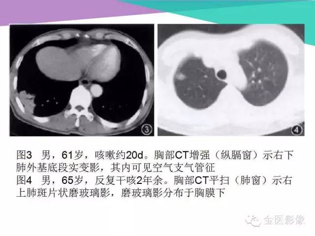 【PPT】隐源性机化性肺炎