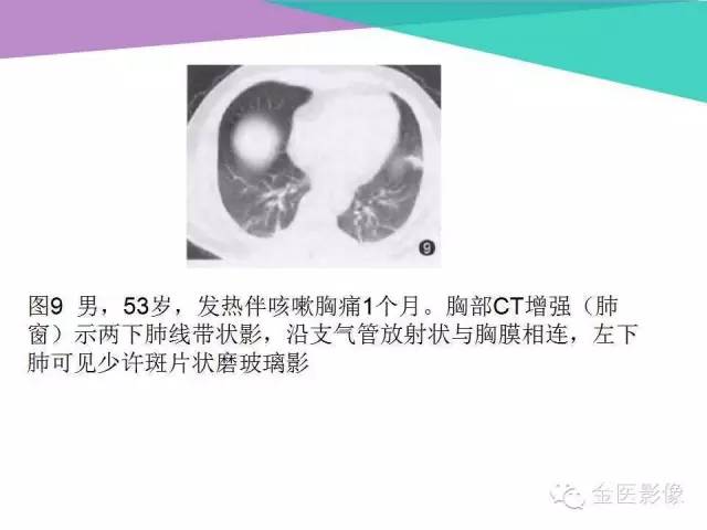 【PPT】隐源性机化性肺炎