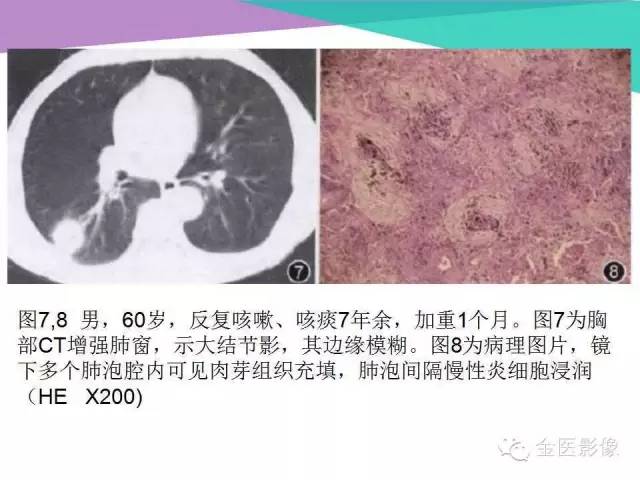 【PPT】隐源性机化性肺炎