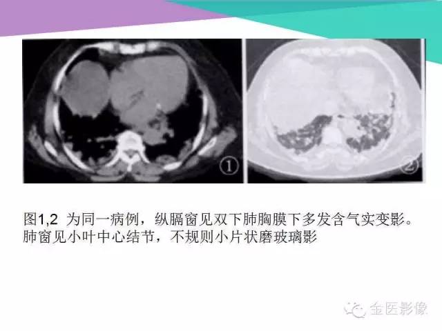【PPT】隐源性机化性肺炎