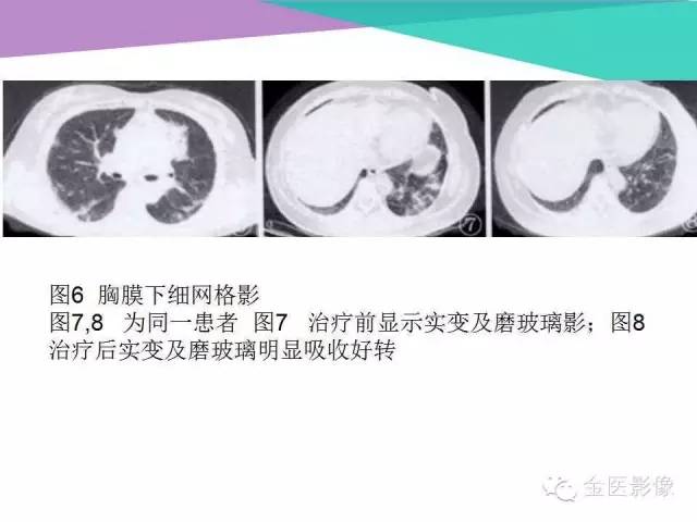 【PPT】隐源性机化性肺炎