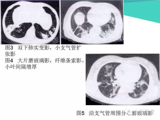 【PPT】隐源性机化性肺炎