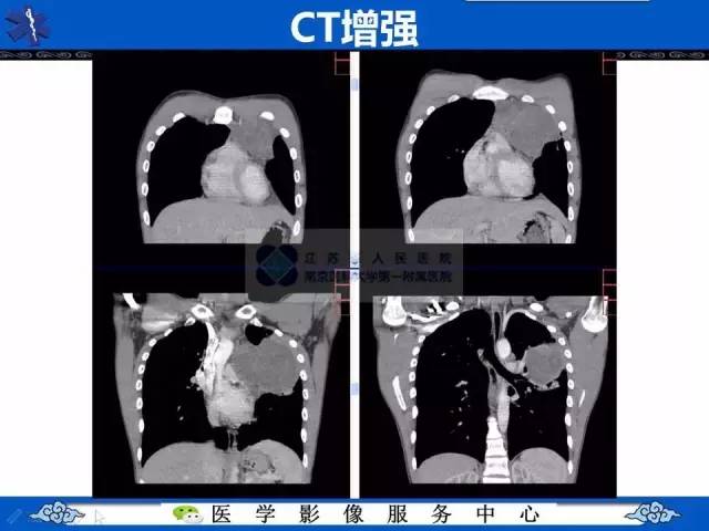 【病例】纵隔内胚窦瘤1例CT影像表现