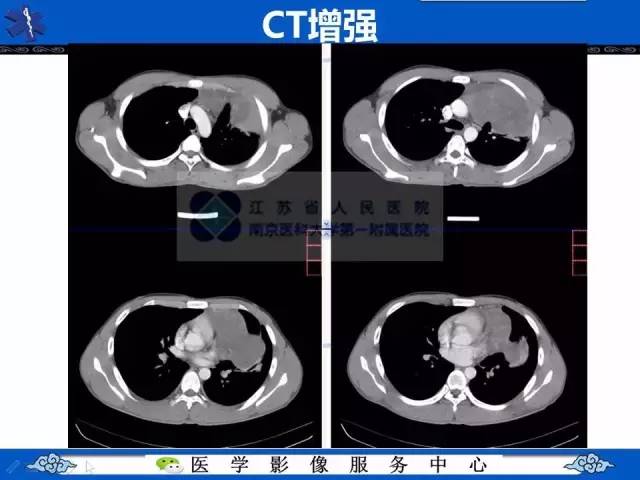【病例】纵隔内胚窦瘤1例CT影像表现