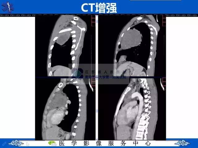 【病例】纵隔内胚窦瘤1例CT影像表现