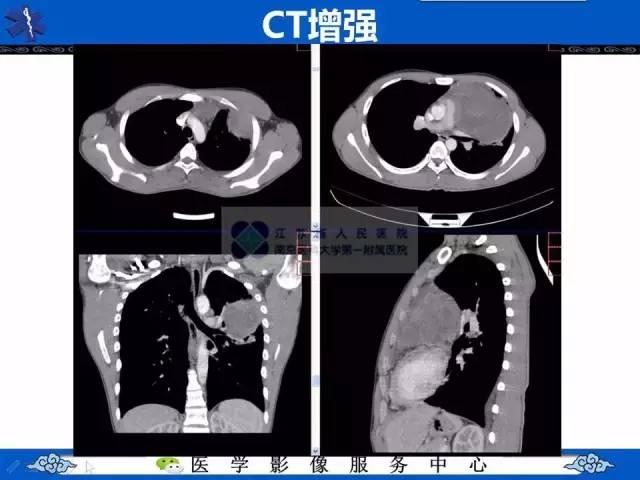 【病例】纵隔内胚窦瘤1例CT影像表现
