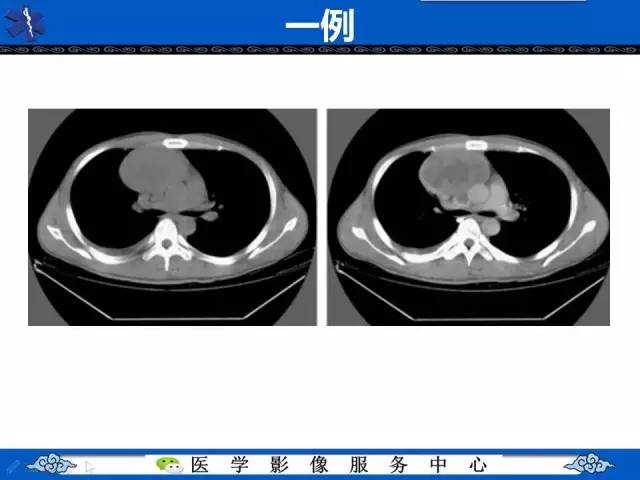 【病例】纵隔内胚窦瘤1例CT影像表现
