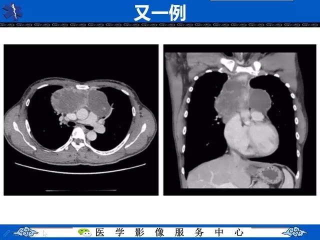 【病例】纵隔内胚窦瘤1例CT影像表现