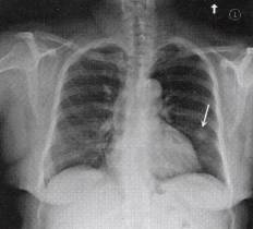 “爆米花样钙化征” 的影像表现与临床意义