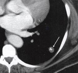 “爆米花样钙化征” 的影像表现与临床意义