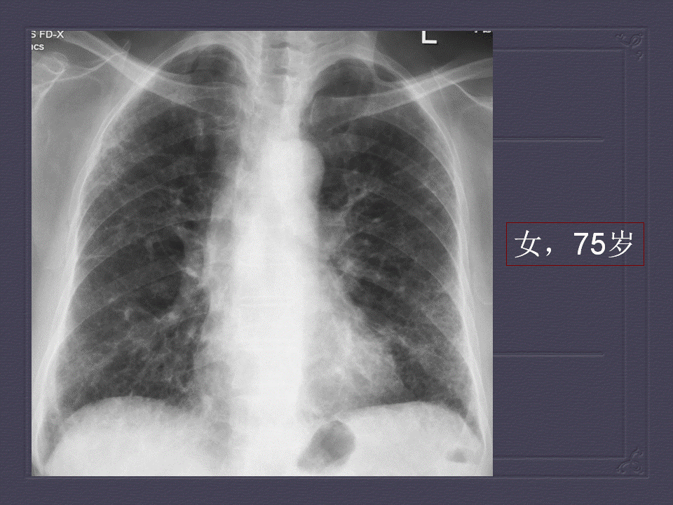 【PPT】弥漫性肺部疾病影像诊断及鉴别