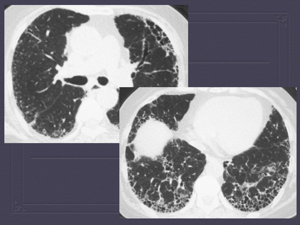 【PPT】弥漫性肺部疾病影像诊断及鉴别