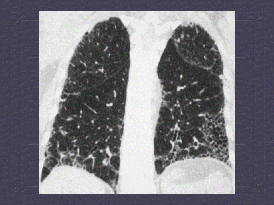 【PPT】弥漫性肺部疾病影像诊断及鉴别