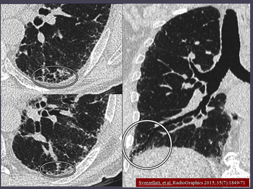 【PPT】弥漫性肺部疾病影像诊断及鉴别