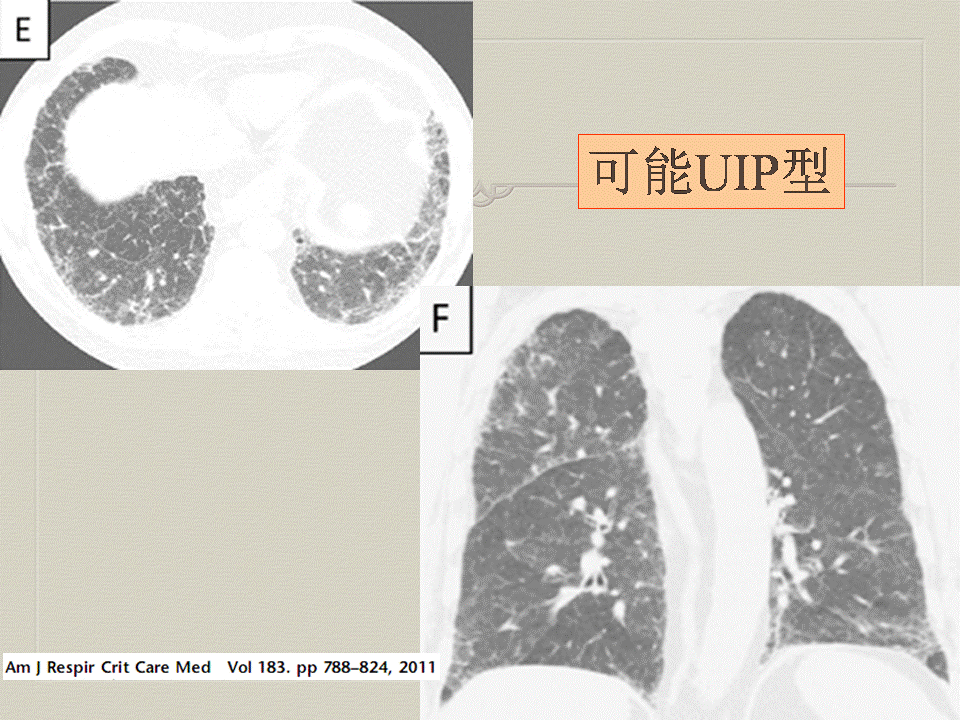 【PPT】弥漫性肺部疾病影像诊断及鉴别