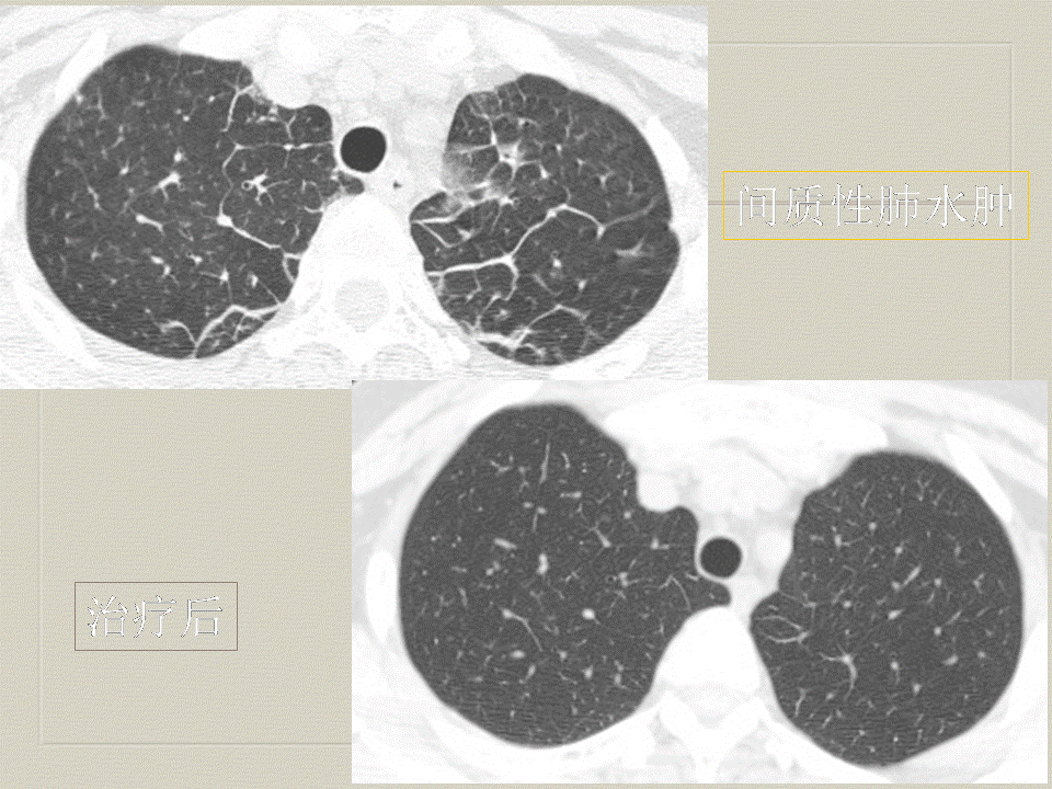 【PPT】弥漫性肺部疾病影像诊断及鉴别