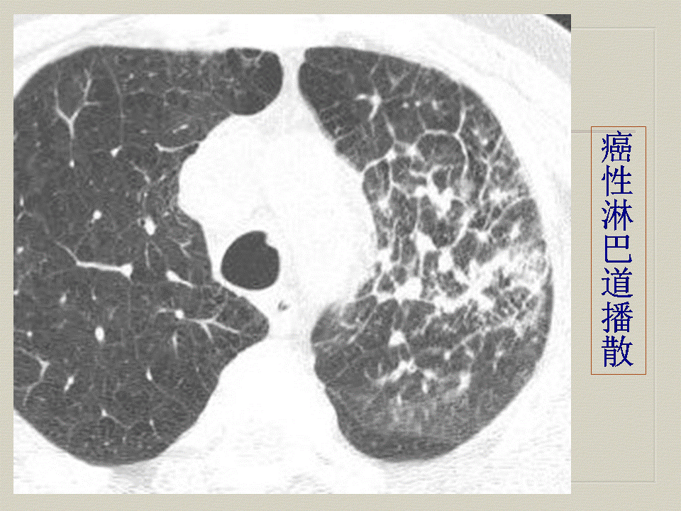 【PPT】弥漫性肺部疾病影像诊断及鉴别