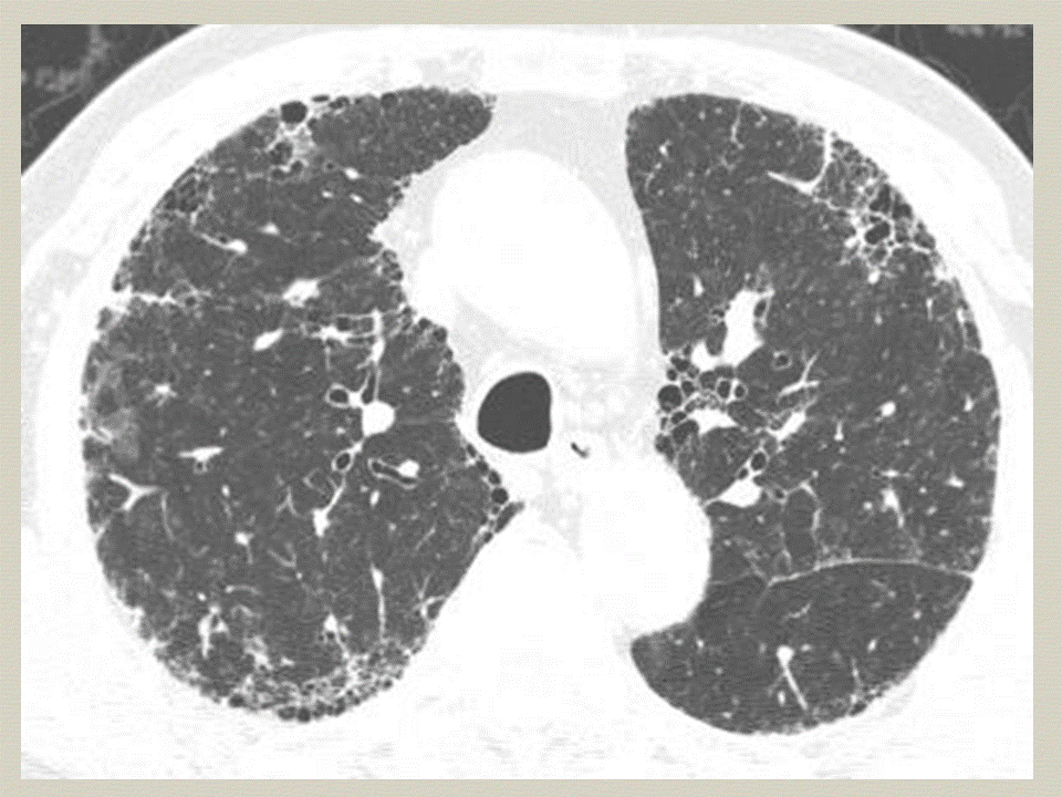 【PPT】弥漫性肺部疾病影像诊断及鉴别