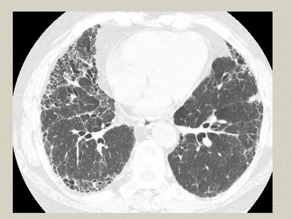 【PPT】弥漫性肺部疾病影像诊断及鉴别