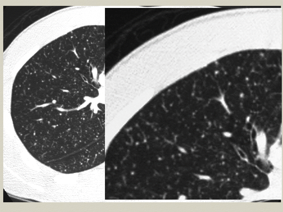 【PPT】弥漫性肺部疾病影像诊断及鉴别