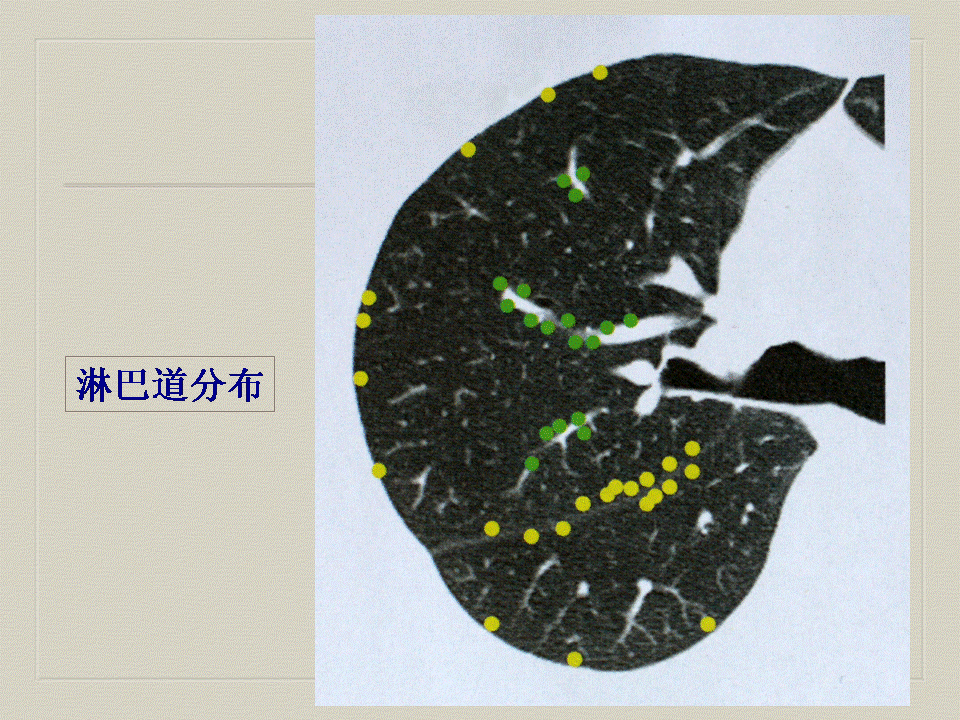 【PPT】弥漫性肺部疾病影像诊断及鉴别