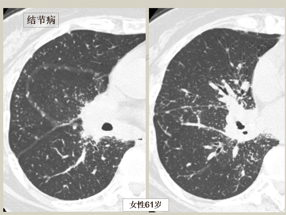 【PPT】弥漫性肺部疾病影像诊断及鉴别