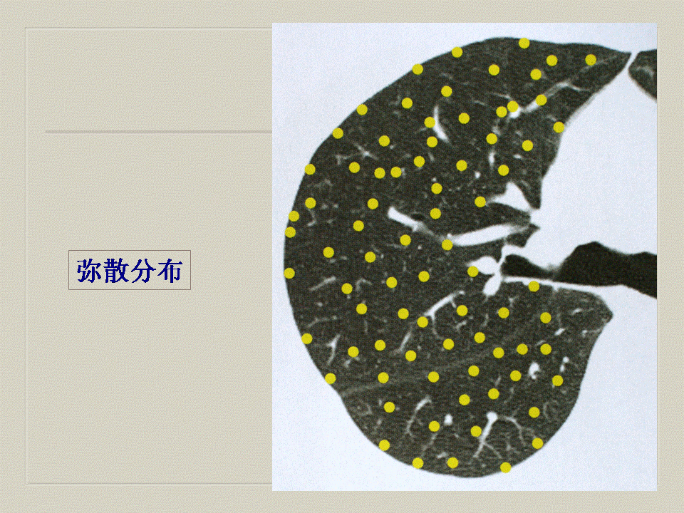 【PPT】弥漫性肺部疾病影像诊断及鉴别