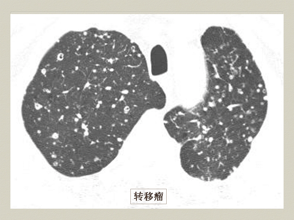 【PPT】弥漫性肺部疾病影像诊断及鉴别