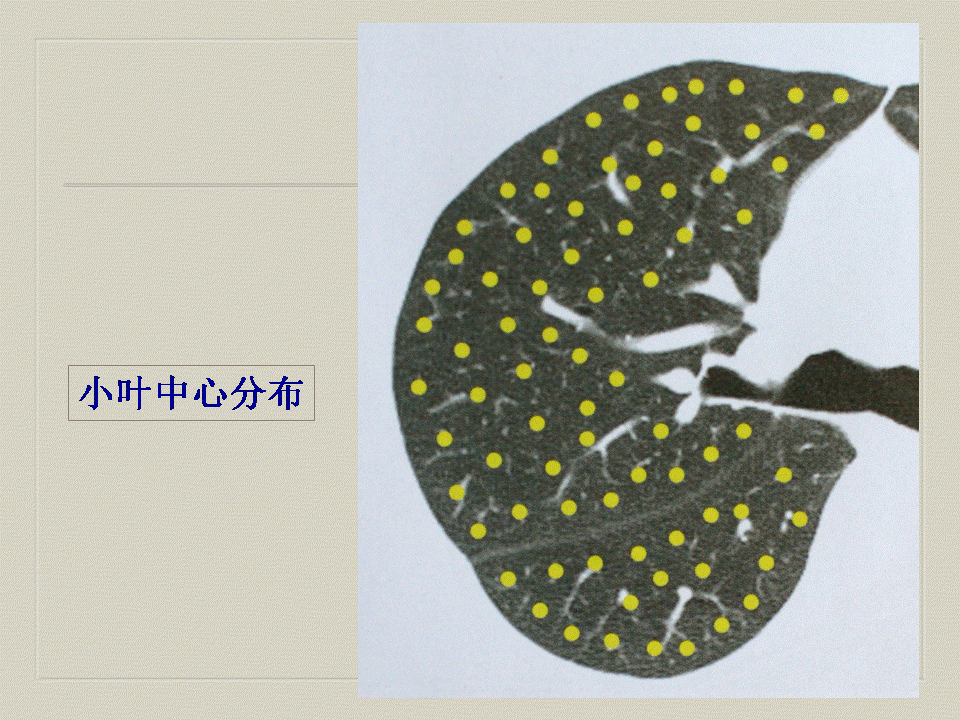 【PPT】弥漫性肺部疾病影像诊断及鉴别