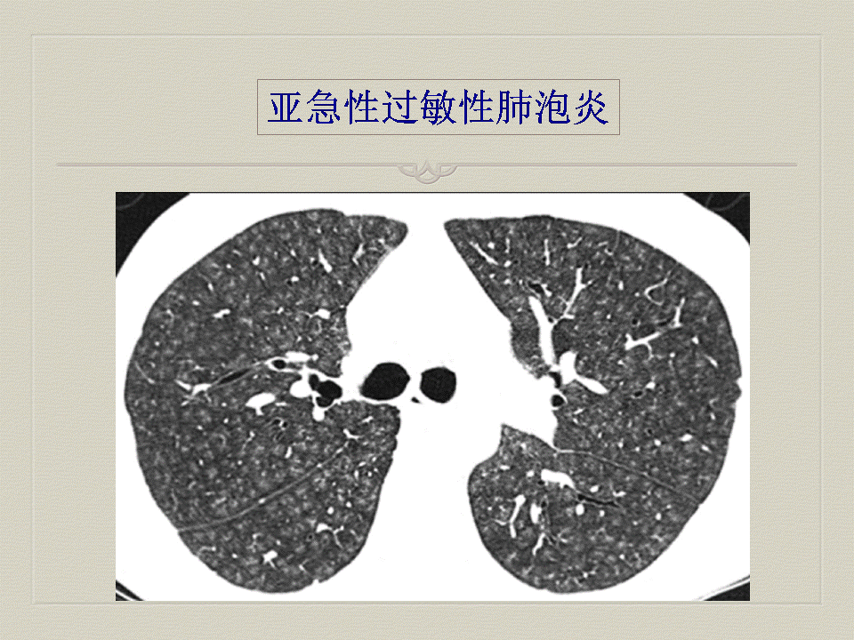 【PPT】弥漫性肺部疾病影像诊断及鉴别