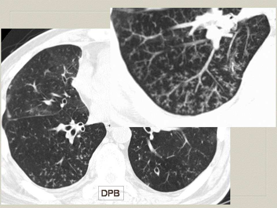 【PPT】弥漫性肺部疾病影像诊断及鉴别