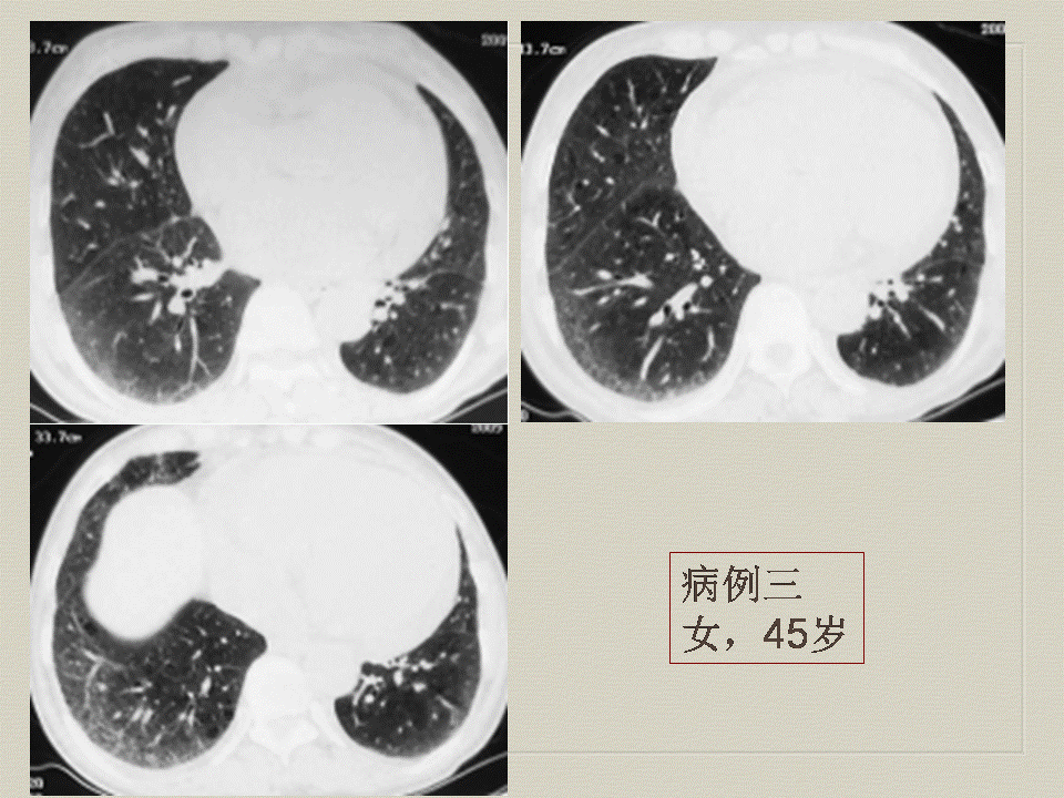 【PPT】弥漫性肺部疾病影像诊断及鉴别