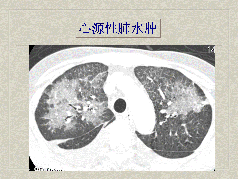 【PPT】弥漫性肺部疾病影像诊断及鉴别