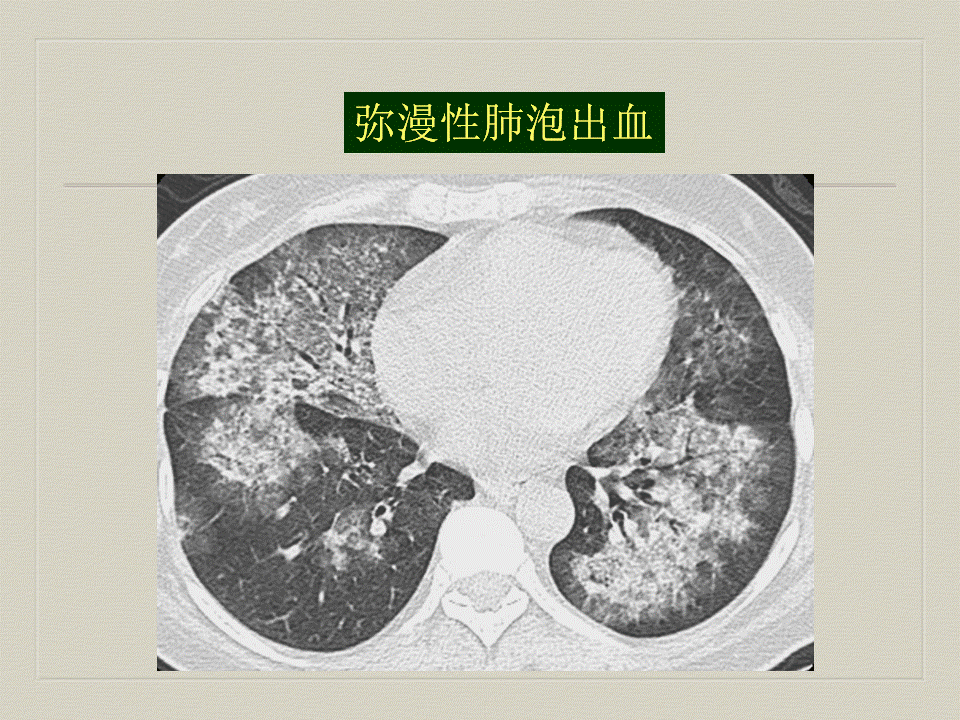【PPT】弥漫性肺部疾病影像诊断及鉴别