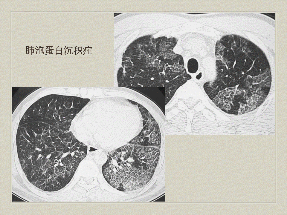 【PPT】弥漫性肺部疾病影像诊断及鉴别