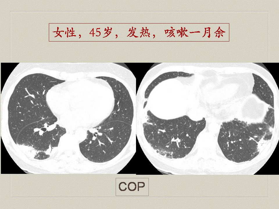 【PPT】弥漫性肺部疾病影像诊断及鉴别