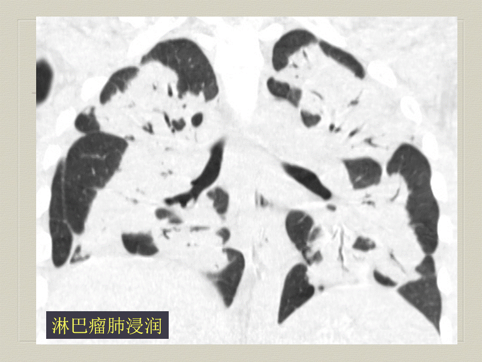 【PPT】弥漫性肺部疾病影像诊断及鉴别