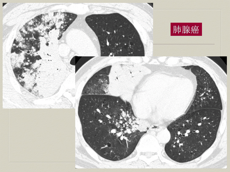 【PPT】弥漫性肺部疾病影像诊断及鉴别