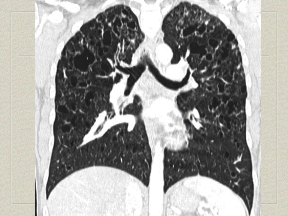 【PPT】弥漫性肺部疾病影像诊断及鉴别