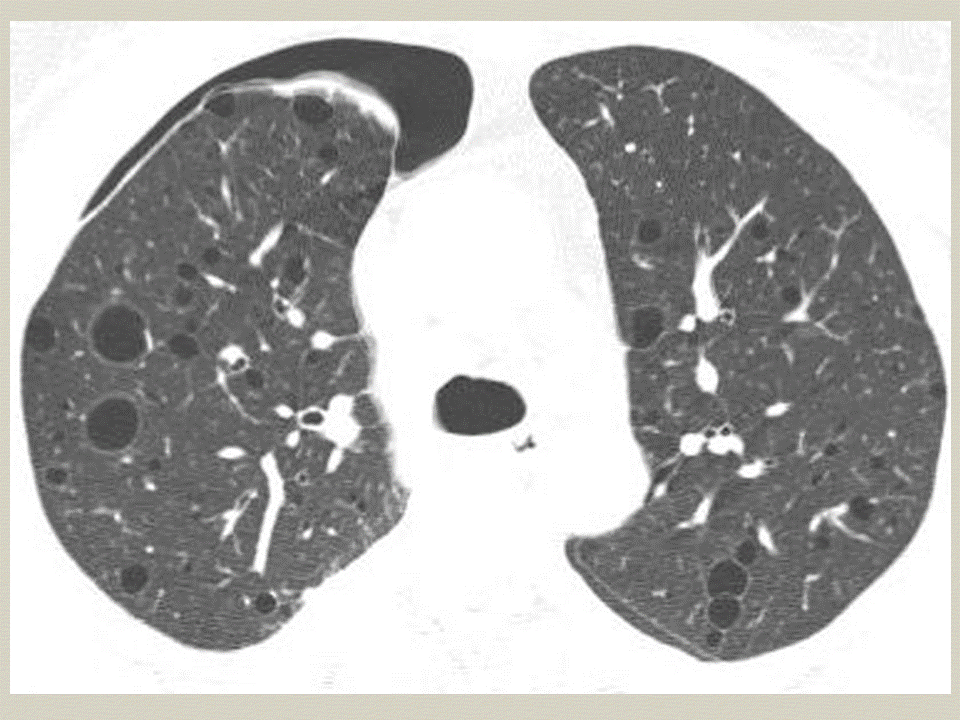 【PPT】弥漫性肺部疾病影像诊断及鉴别