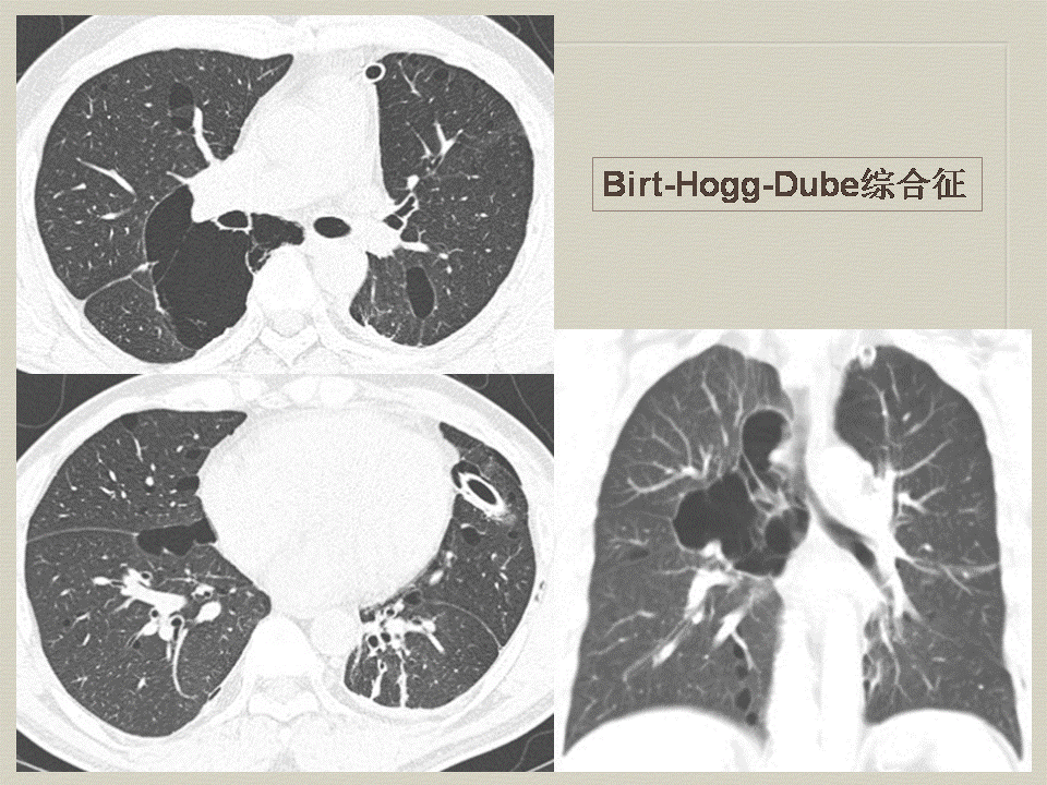 【PPT】弥漫性肺部疾病影像诊断及鉴别