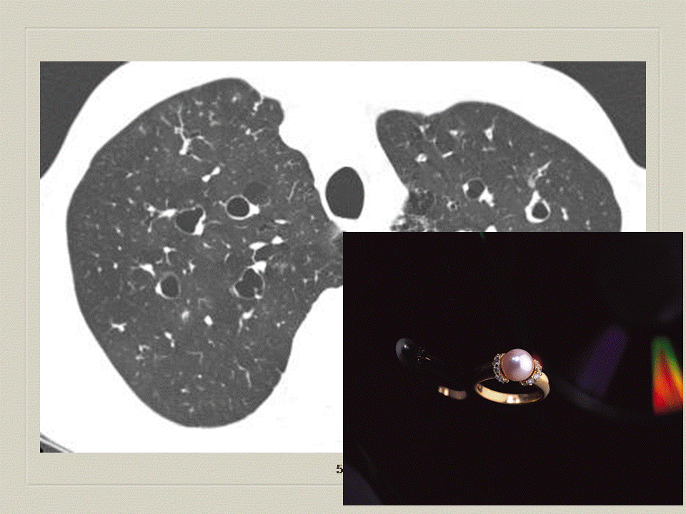 【PPT】弥漫性肺部疾病影像诊断及鉴别