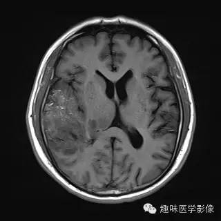 【病例】少突胶质细胞瘤1例MR影像表现
