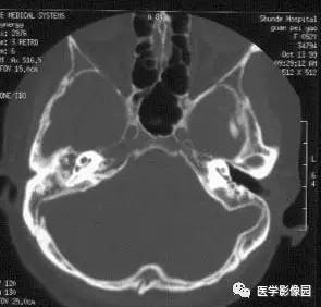 中耳癌  cancer of the middle ear