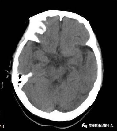 【病例】非酮症高血糖合并偏侧舞蹈症1例CT影像表现