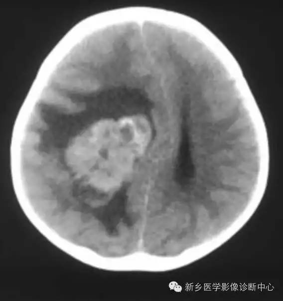 【病例】血管周围细胞瘤1例CT MR影像表现与鉴别