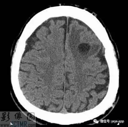【病例】左侧额叶环形强化病变——囊虫病1例CT及MR
