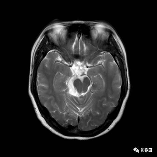 【病例】桥小脑脚区表皮样囊肿1例MR影像表现