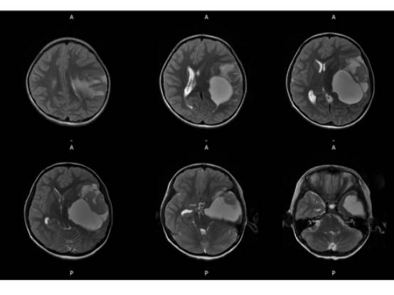 【病例】左颞血管周细胞瘤1例MR