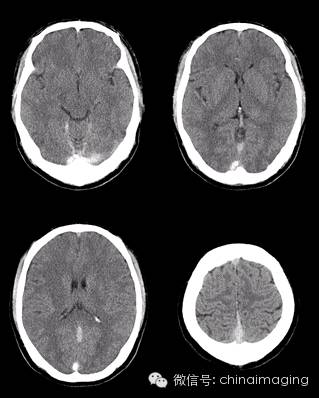 【病例】脑静脉窦血栓一例影像表现